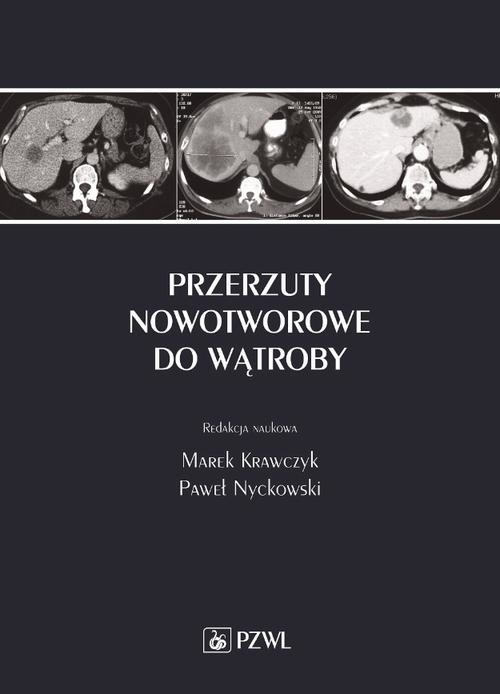 okładka Przerzuty nowotworowe do wątroby ebook | epub, mobi | Opracowania Zbiorowe